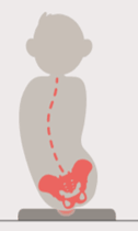 Pelvic Obliquity (frontal pelvic angle)